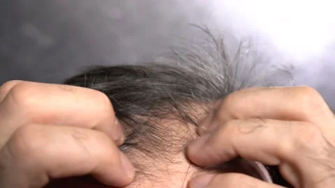 Hair Loss Problem in Old Age Men Stock Footage 166105940