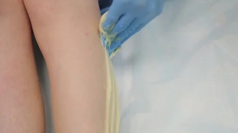 Hair removal using shugaring, closeup Stock Footage 83243288