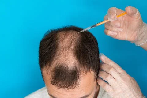 The Hair Restoration Procedure involves advanced Injection Treatments for Stock Photos