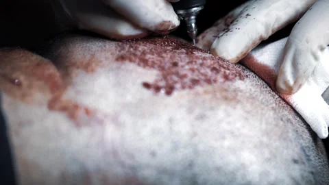 Hair transplant procedures Stock Footage 245111453