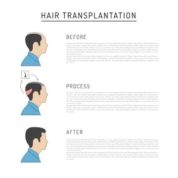 Hair transplantation vector Stock Illustration