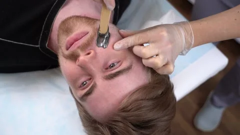 Hairy face man using wax epilation at beauty saloon Body hair removal wax warmer Vidéo 149583555