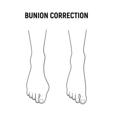 Hallux valgus, bunion correction Stock Illustration