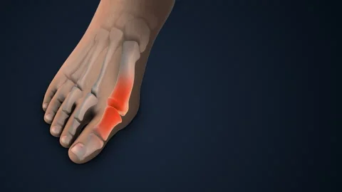 Hallux Valgus Correction Bunion Surgery in foot Vídeos de archivo 276266938