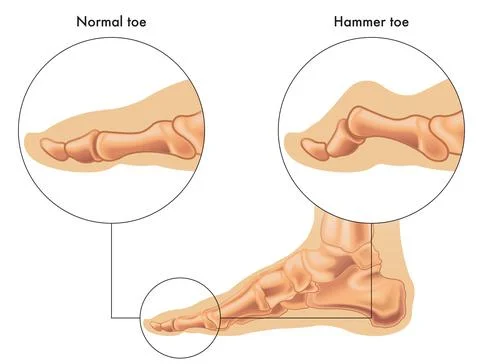 Hammer toe Stock Illustration