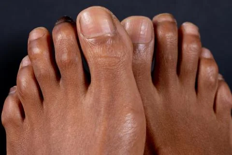 Hammer toe or claw toe of a mixed-race woman in front of black background. Stock Photos