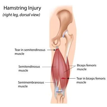 Hamstring injury Stock Illustration