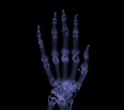 Hand 3D rendering for rheumatoid arthritis Concept. Stock-Illustration