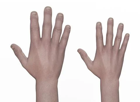 Hand with acromegaly and the same healthy hand, 3D illustration Illustrazione stock