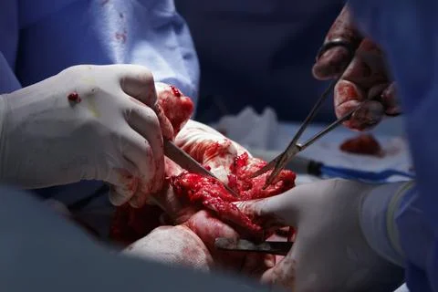 Hand Amputation Close-Up Stockfoto's