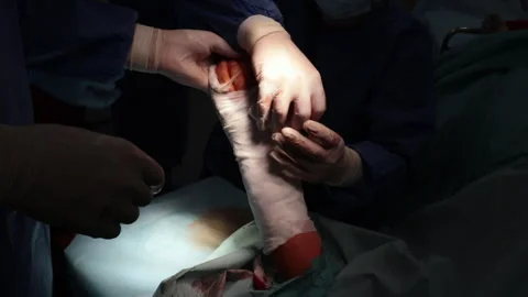 Hand bandaging after surgery Stock Footage 247249702