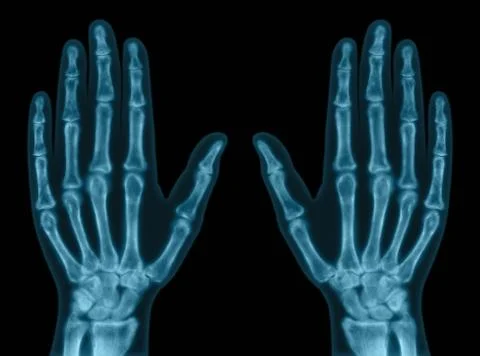 Hand Bones Stock Photos