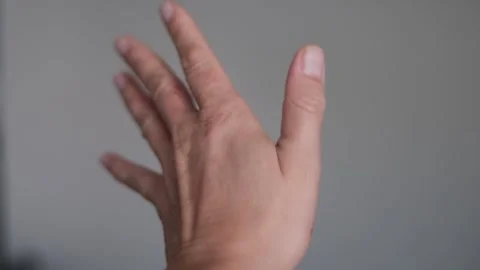 Hand close-up rotating shows chronic eczema dryness Stock Footage 310913933