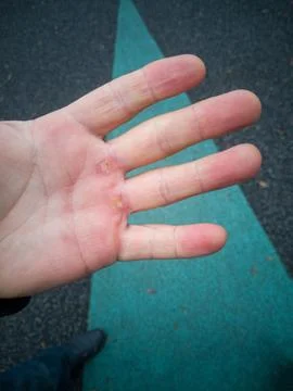 Hand with corn, callus on the palm Stock Photos