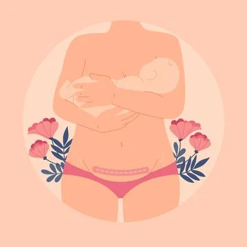 Hand drawn flat design cesarean section Stock Illustration