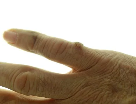 Hand of an elderly man on white background showing a benign malformation Stock Photos