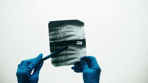 Hand fingers x-ray close-up. Magnetic Resonance Image of human arm. Doctor Stock Footage 169198727