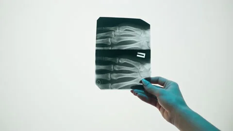 Hand fingers x-ray close-up. Magnetic Resonance Image of human arm. Doctor Stock Footage 169198935