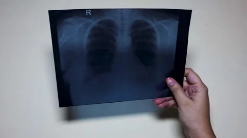 Hand Holding Chest X Ray Film Showing Human Lungs For Medical Examination A.. Stock Footage 341693354