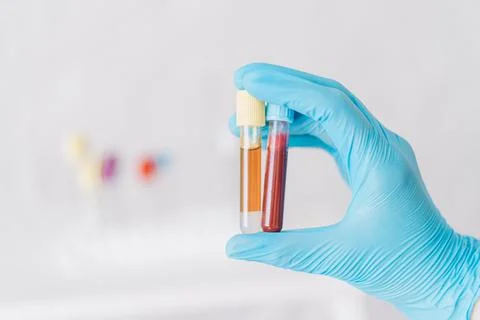 Hand holding two test tubes with blood and plasma against the background of Foto stock
