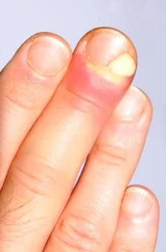 Hand infection Stock Photos