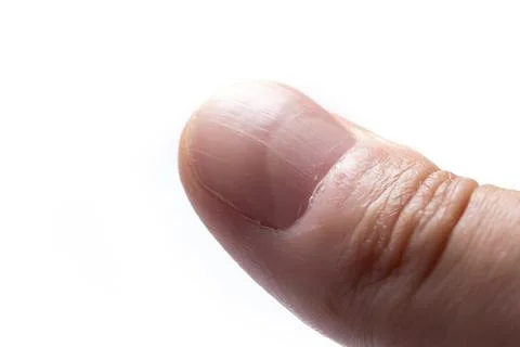 Hand with longitudinal ridging nails isolated on white background Stock Photos