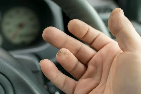 Hand of a man with a missing finger phalanx Stock Photos
