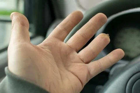 Hand of a man with a missing finger phalanx Stock Photos