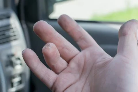 Hand of a man with a missing finger phalanx Stock Photos