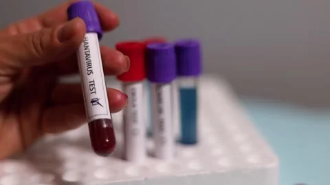 Hand Marking Hantavirus Blood Sample Tube with Permanent Marker Stock Footage 335659085