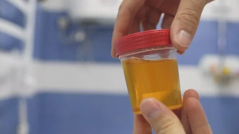 Hand mixes the urine sample container and demonstrates the analysis container Stock Footage 103523235
