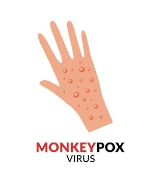 Hand with monkeypox flat design vector Illustration. Disease spread alert...O Stock Illustration