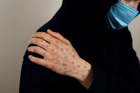Hand with monkeypox rash on shoulder Stock Photos