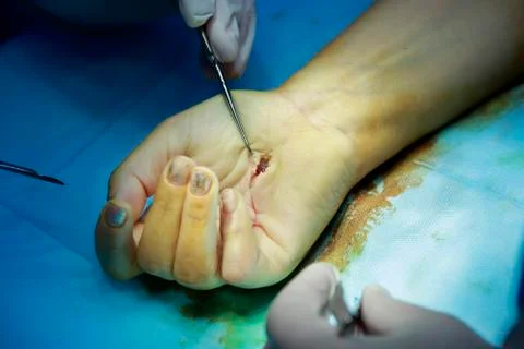 Hand with open wound Stockfoto's