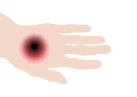 Hand with red, cutaneous anthrax skin lesion featuring dark center Stock Illustration