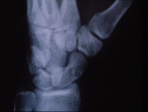 Hand root bone after accident in x-ray image Stock Photos