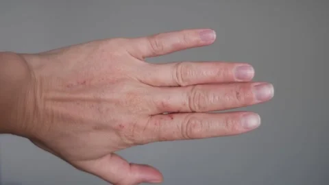 Hand rotation with eczema Stock Footage 310914021