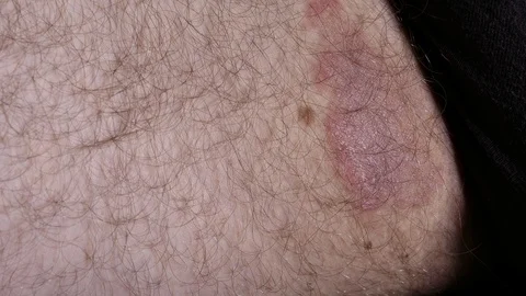 Hand rubbing cream into fungal Stock Video Pond5