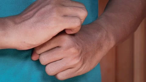 Hand Scratching itchy wrist Stock Footage 335867602