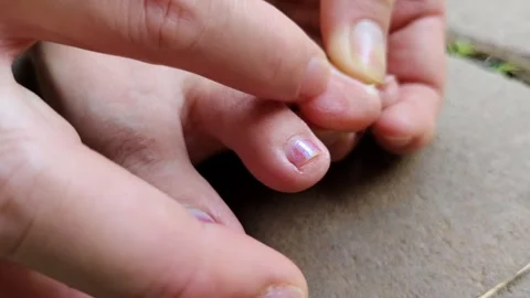 Hand scratching a toe affected by tinea pedis or athlete's foot Stock Footage 304789492