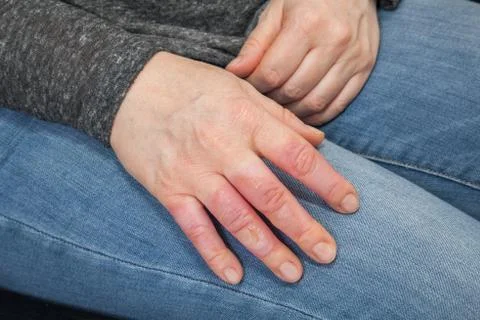 Hand with second degree burns Stock Photos