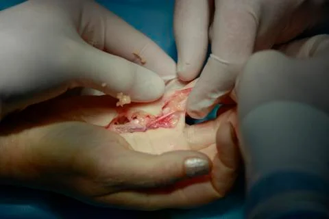 Hand surgery closeup Stockfoto's