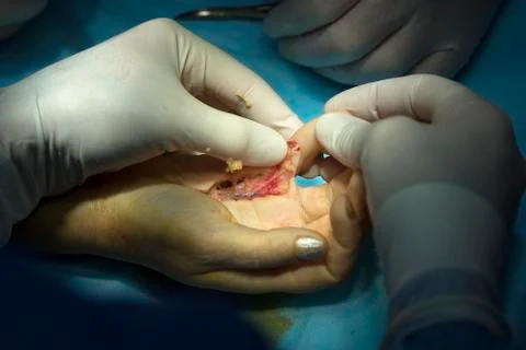 Hand Surgery with open wound Photos