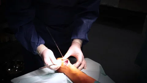 Hand surgery in operating room Stock Footage 248035889