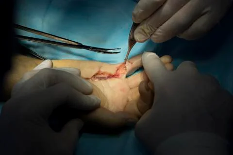 Hand surgery with tools closeup Photos