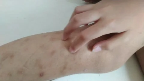 Hand Touching Skin Showing Marks on Leg Close Up Stock Footage 309066264