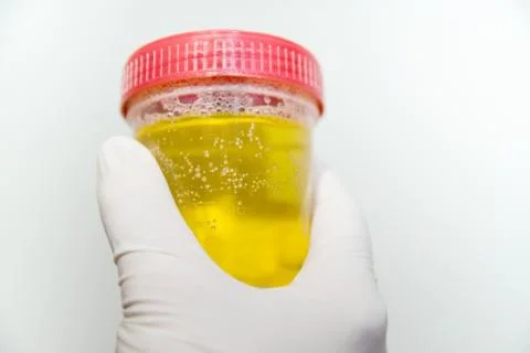 Hand with urine container.. Stock Photos
