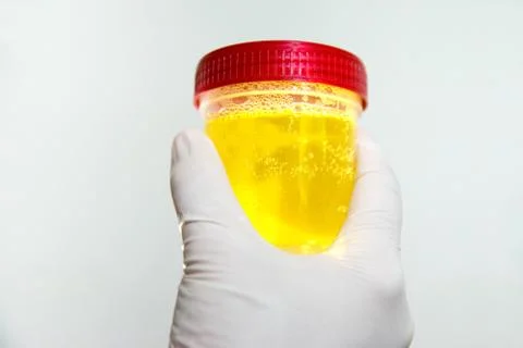 Hand with urine container.. Stock Photos