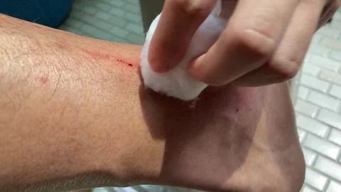 Hand using clean hygienic cotton to treat fresh wound on man's leg Stock Footage 253248312