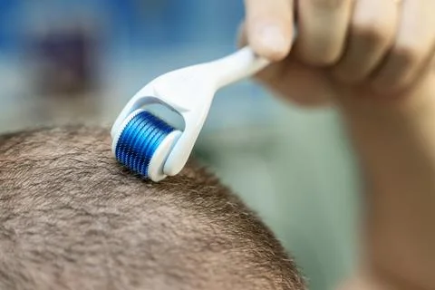 Hand using a microneedle roller on a balding scalp to stimulate hair growth.. Stock Photos